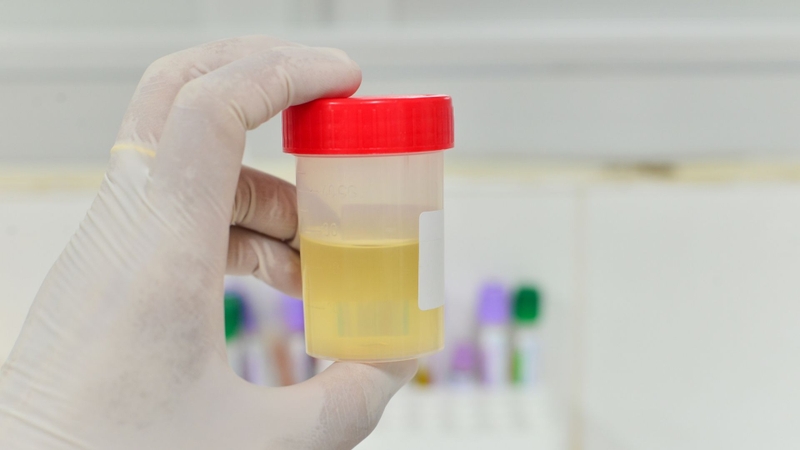 Nước tiểu bình thường không có protein hoặc chỉ chứa một lượng rất nhỏ