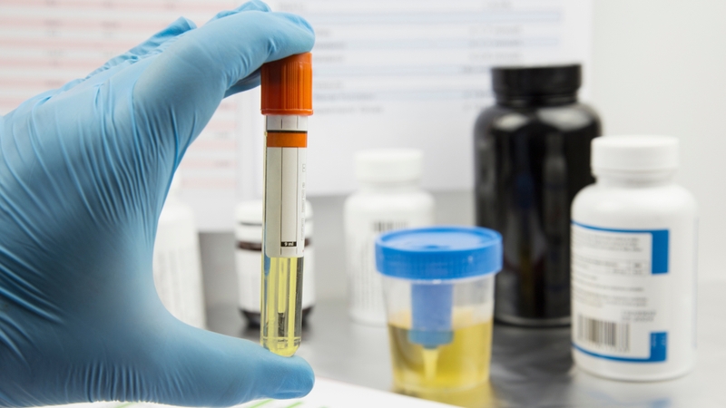 Xét nghiệm nước tiểu có biết bị tiểu đường không? Giải đáp chi tiết và dễ hiểu 1