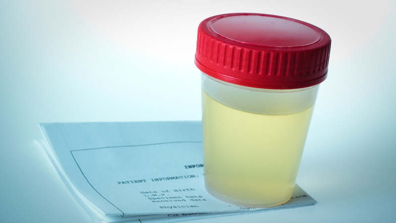 Xét nghiệm nước tiểu có biết bị tiểu đường không? Giải đáp chi tiết và dễ hiểu 3