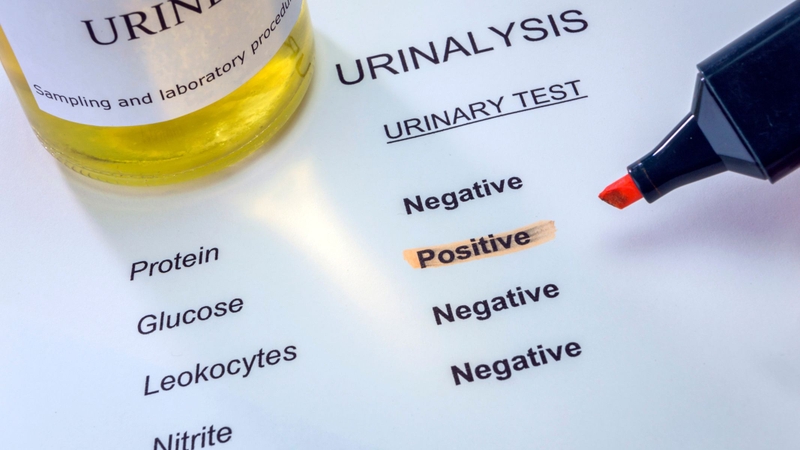 Nếu chỉ số GLU tăng, điều này cho thấy đường huyết cao bất thường hoặc rối loạn tái hấp thu tại ống thận