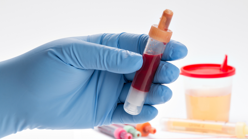 PDW trong xét nghiệm máu (Platelet Distribution Width) là chỉ số đo độ phân bố kích thước của tiểu cầu