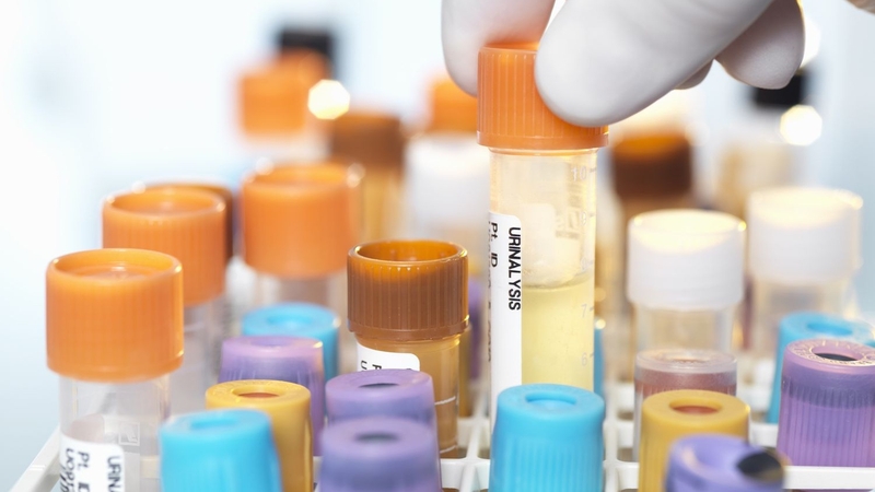 Xét nghiệm protein niệu 24 giờ là gì? Có tác dụng gì? 1