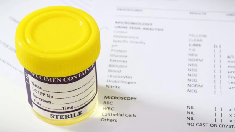 Kỹ thuật ly tâm và soi mẫu nước tiểu để phát hiện ấu trùng sán máng