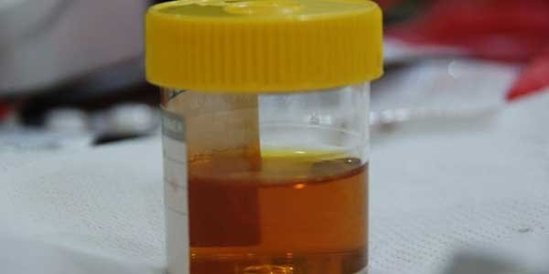 Xét nghiệm soi cặn lắng nước tiểu là một loại xét nghiệm đơn giản nhưng rất quan trọng đối với sức khỏe của bạn