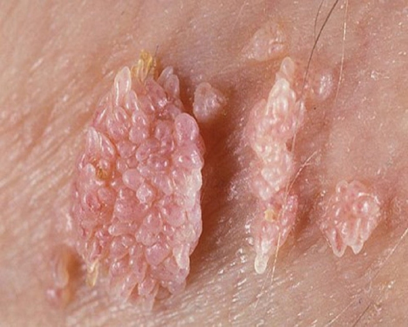 Bệnh sùi mào gà biểu hiện bằng các u nhú, mụn cóc, và mụn thịt trên da