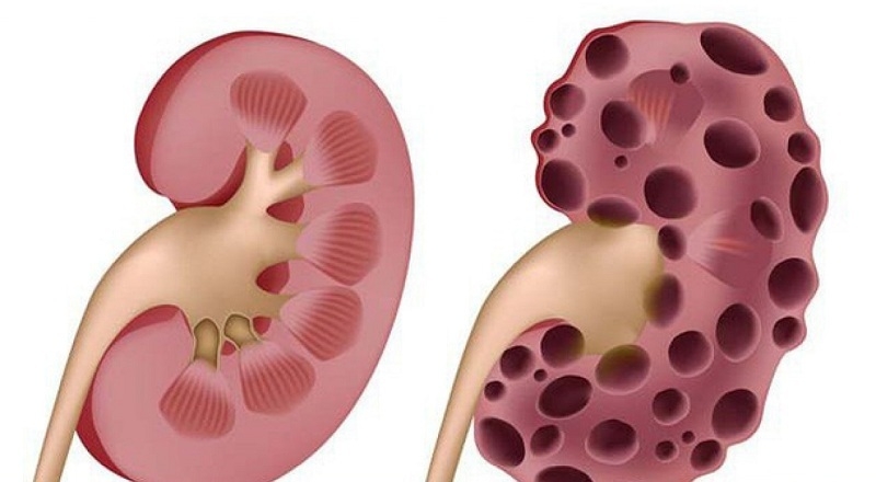 Suy thận là tình trạng thận không có khả năng lọc các chất cặn bã trong máu ra ngoài cơ thể