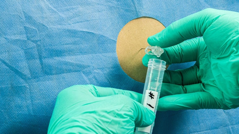 Tùy trường hợp cụ thể, xét nghiệm theo dõi biến chứng sẽ được chỉ định thêm