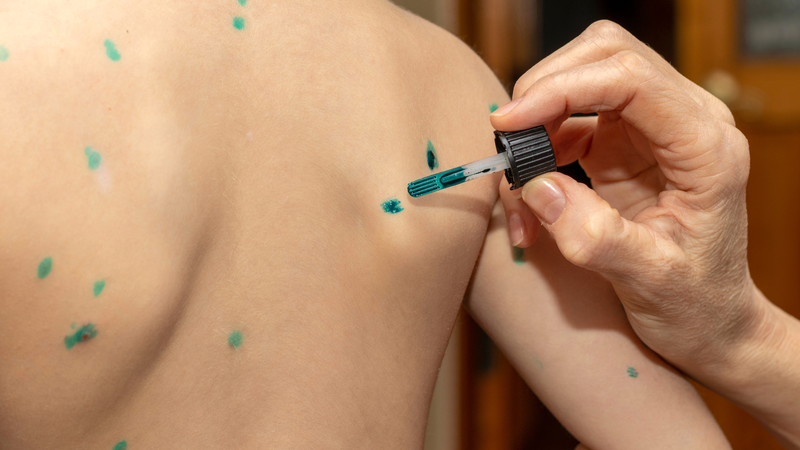 Nhiều bậc cha mẹ muốn biết&nbsp;trẻ bị tay chân miệng có nên bôi xanh methylen