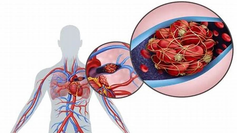 Xét nghiệm TCK là gì? Vai trò của TCK trong chẩn đoán rối loạn đông máu 4