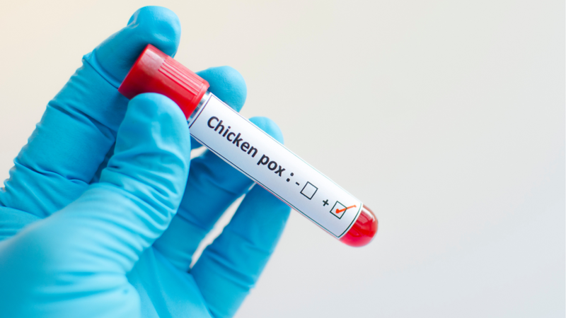 Xét nghiệm thủy đậu và những câu hỏi thường gặp 3
