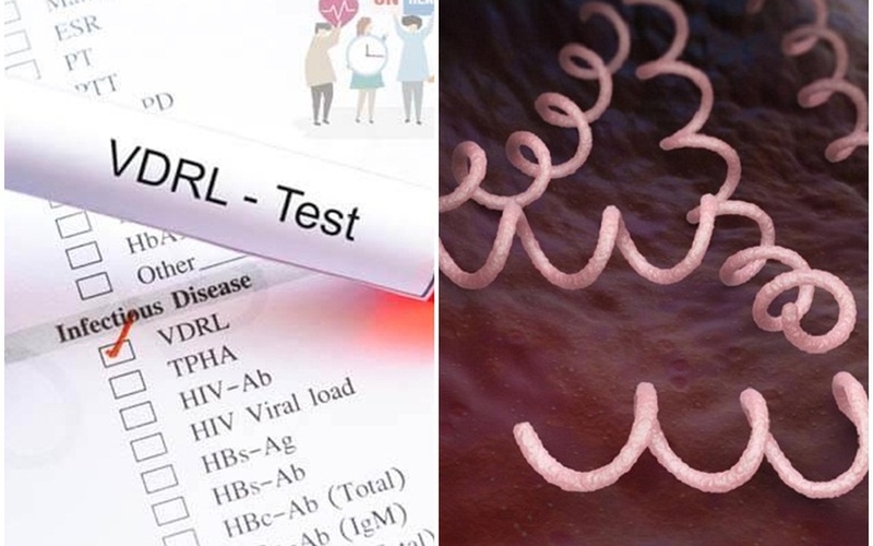 Xét nghiệm VDRL là gì? Tại sao cần làm xét nghiệm VDRL? 1