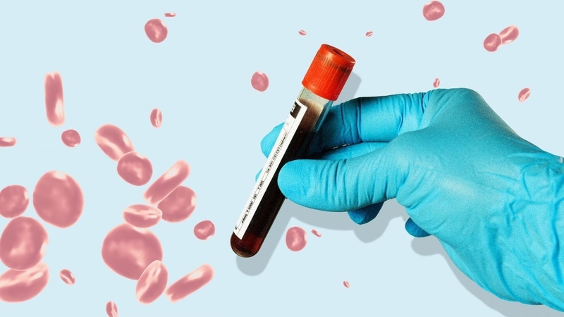 Anti-HEV IgM là xét nghiệm thường dùng để phát hiện nhiễm virus viêm gan E mới mắc