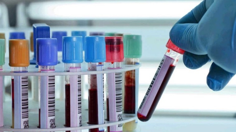 Xét nghiệm viêm gan C bao nhiêu tiền? Những thông tin bạn cần biết 3