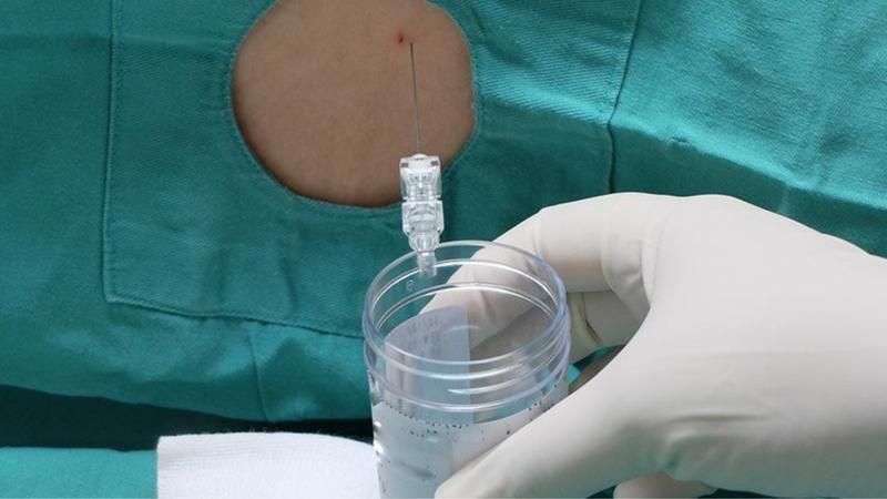 Xét nghiệm viêm màng não bằng cách nào? 2