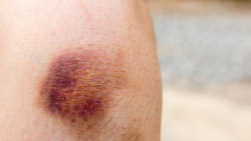 Bầm tím không rõ nguyên nhân có thể là dấu hiệu xuất huyết giảm tiểu cầu