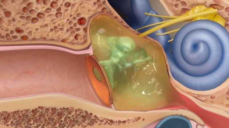 Xì mũi mạnh gây thủng màng nhĩ có thật không? 2