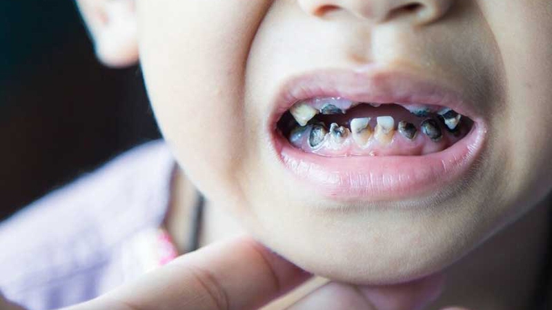 Xiết ăn răng ở trẻ em: Nguyên nhân, triệu chứng và cách xử lý 1
