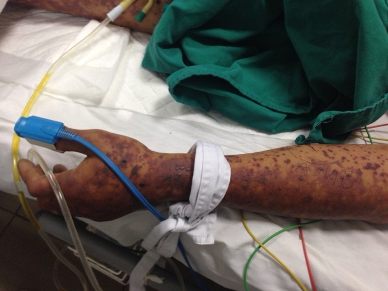 Ăn tiết canh dê bị viêm cầu lợn không?-2