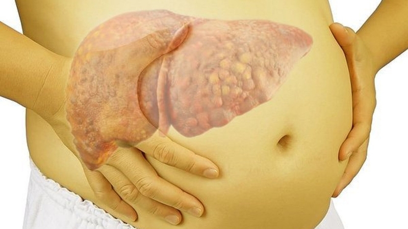 Xơ gan cổ trướng có chữa được không? Hướng điều trị xơ gan cổ trướng 3