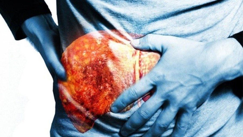 Xơ gan F1 gần như không được phát hiện thông qua triệu chứng lâm sàng