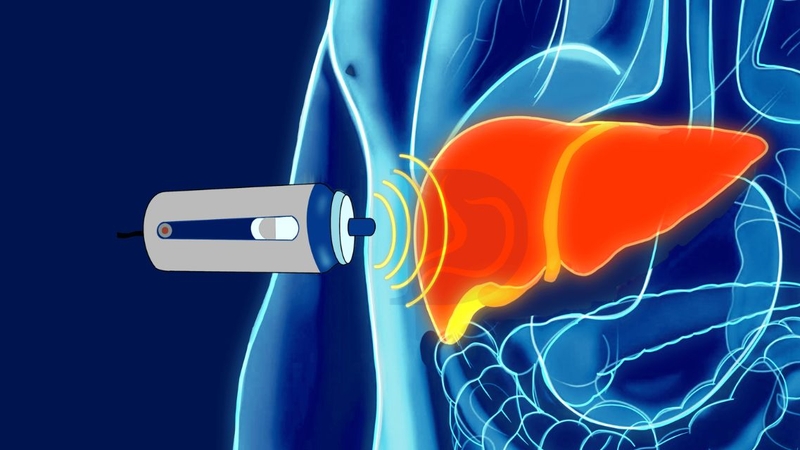Kiểm tra mức độ xơ hóa gan bằng FibroScan