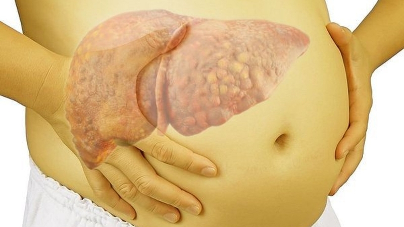 Xơ gan giai đoạn 2 có nguy hiểm không? 2