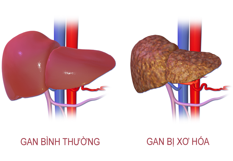 Xơ gan giai đoạn cuối có thể chữa được không?