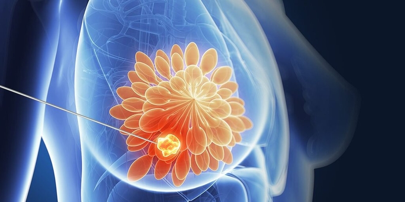 Xơ nang tuyến vú: Triệu chứng, phương pháp chẩn đoán và điều trị 1