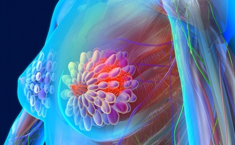 Xơ nang tuyến vú: Triệu chứng, phương pháp chẩn đoán và điều trị 2