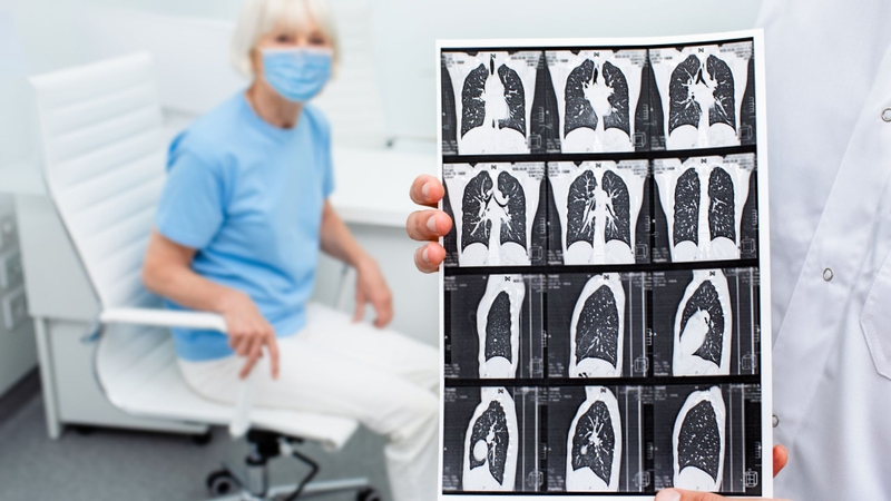 Xơ phổi 1/3 là gì​? Nguyên nhân, triệu chứng và chẩn đoán xơ phổi 1/3 4