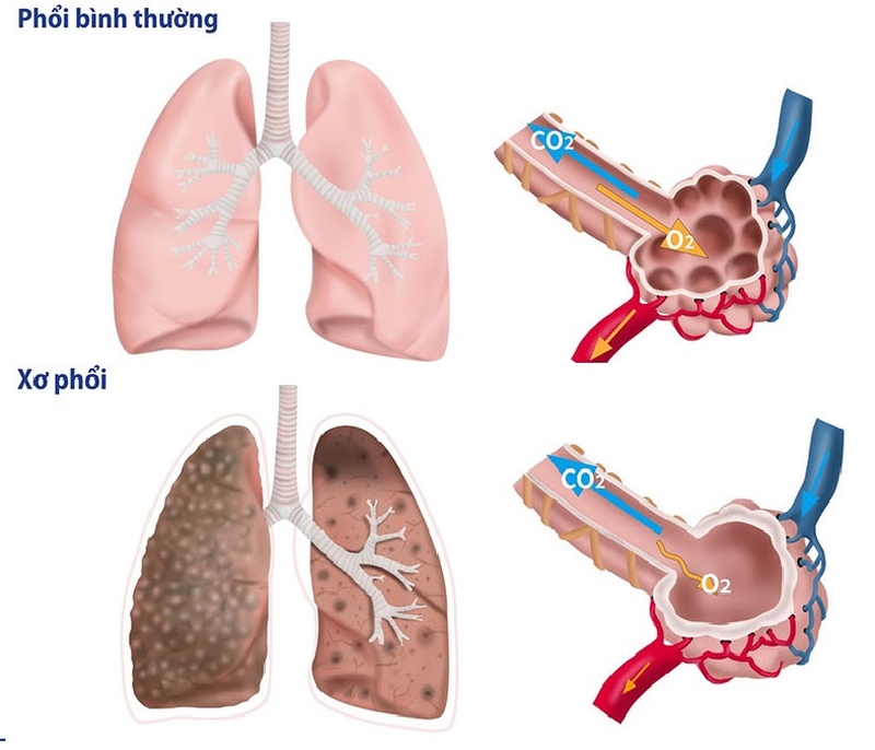 Xơ phổi vô căn là gì? Nguyên nhân, dấu hiệu và cách nhận biết 1