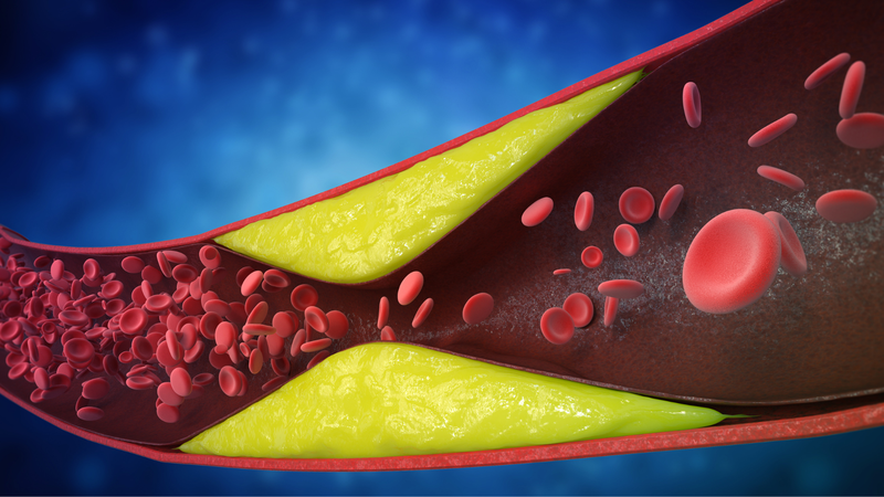 Xơ vữa mạch máu não là gì? Yếu tố nguy cơ gây xơ vữa mạch máu não 1
