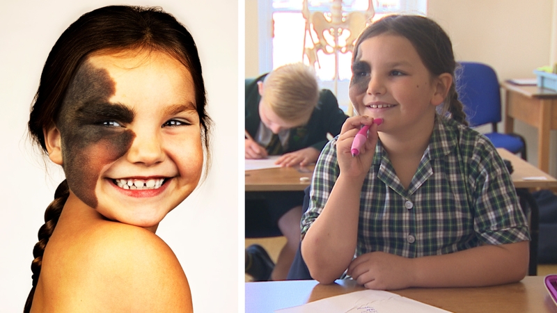 Có thể xóa bớt đen bẩm sinh không? Cách xóa như thế nào 1