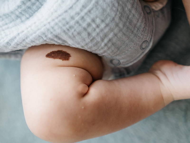 Có thể xóa bớt đen bẩm sinh không? Cách xóa như thế nào 3