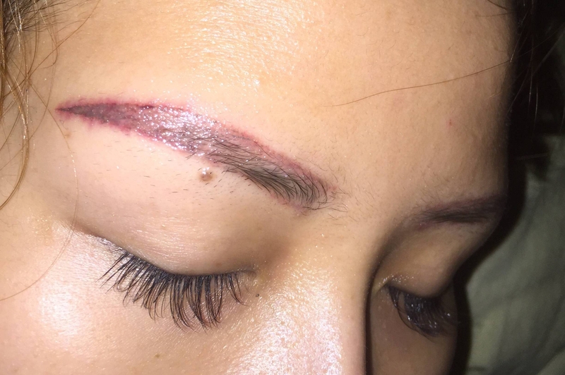 Sau khi xóa laser lông mày bị đỏ - Phải làm sao 2