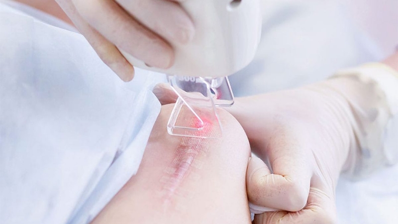 Xóa sẹo bằng laser bao nhiêu tiền? Tìm hiểu chi phí và lợi ích của phương pháp này 3