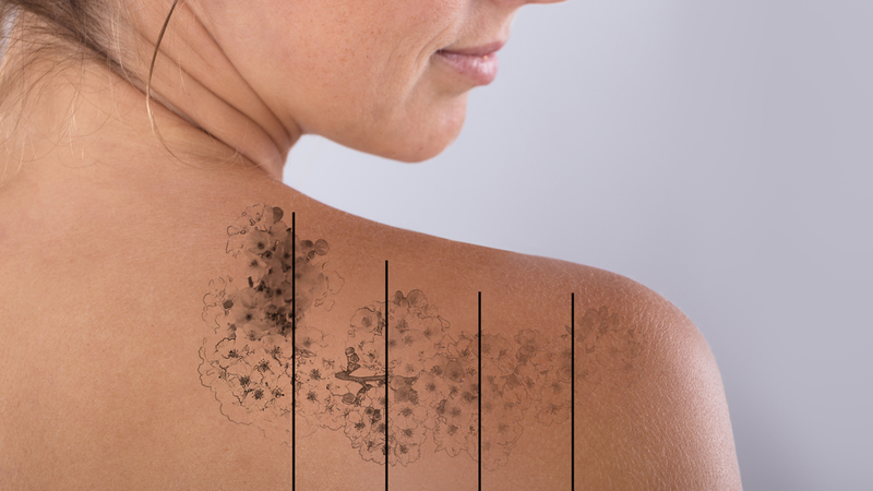 Xóa xăm bằng laser là gì? Có để lại sẹo không? 2