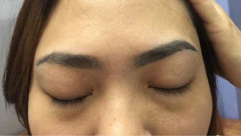 Xoá xăm chân mày bằng laser có hiệu quả không? 1