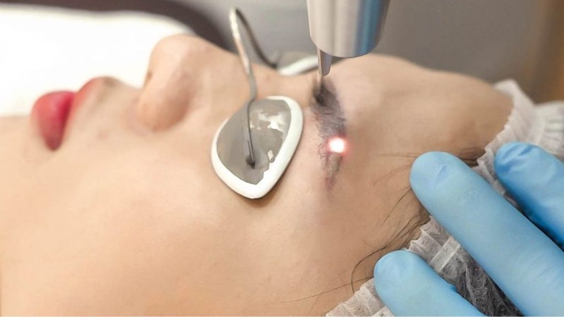 Xoá xăm chân mày bằng laser có hiệu quả không? 3