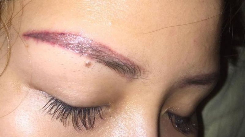 Xoá xăm chân mày: Cứu cánh cho những đôi chân mày hỏng! 1