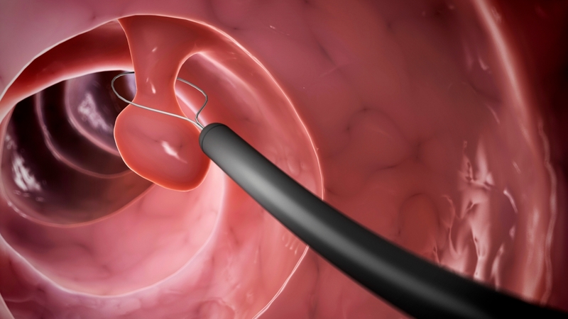 Xoắn polyp cổ tử cung cần được xử trí phù hợp tùy theo mức độ tổn thương, triệu chứng và tình trạng sức khỏe của người bệnh