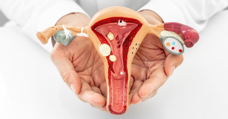 Xoắn polyp cổ tử cung là gì? Thủ thuật xoắn polyp cổ tử cung 3