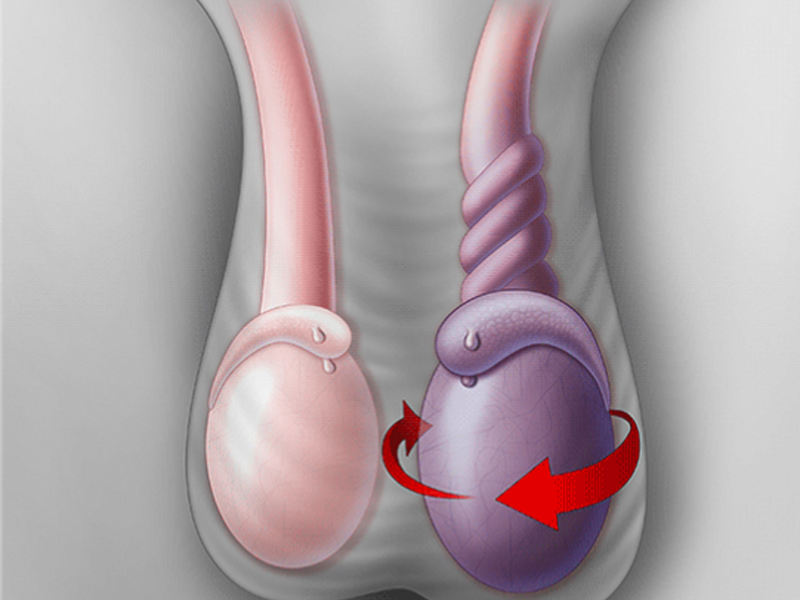 Cẩn trọng với hiện tượng sưng bìu ở trẻ sơ sinh