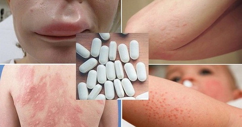 Xử lý dị ứng: Dị ứng thuốc nên uống gì1