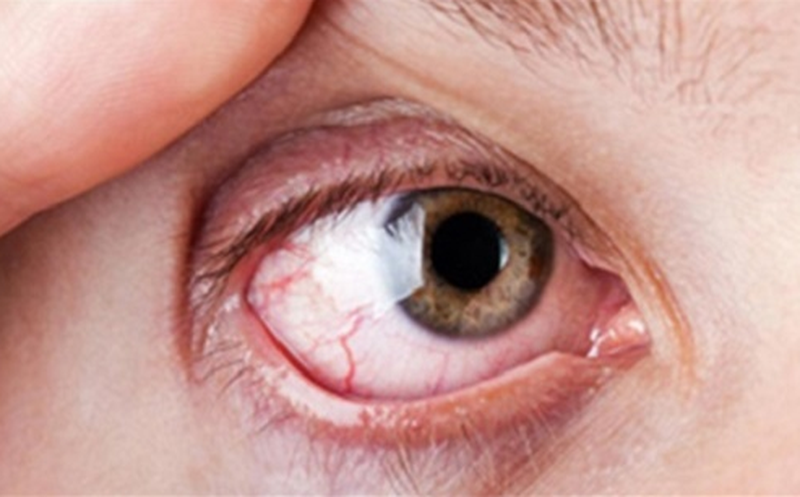 Xử lý lông mi quặm những giải pháp được bác sĩ khuyên sử dụng 1