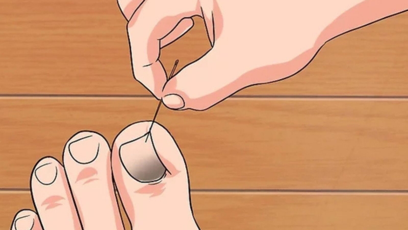 Xử lý móng chân bị hư an toàn 2