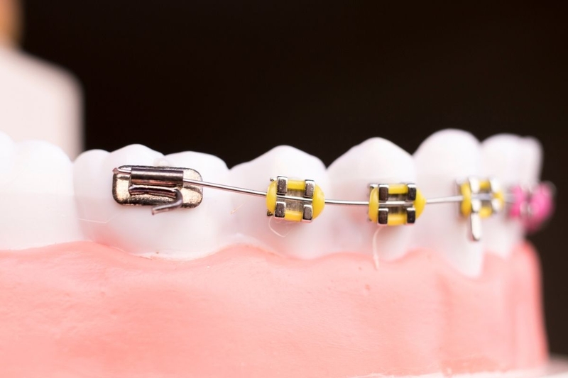 Xử lý sự cố dây cung tuột khỏi mắc cài khi niềng răng như thế nào? 1