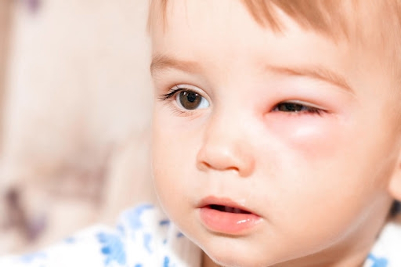 Xử Lý Như Thế Nào Khi Bé Bị Ngã Sưng Mắt? 2