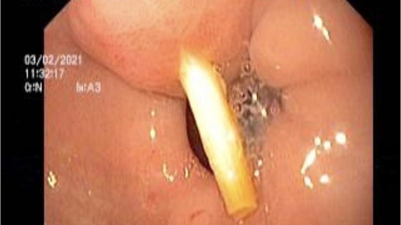 Làm gì khi bị dị vật dạ dày? Các phương pháp điều trị hiệu quả 1