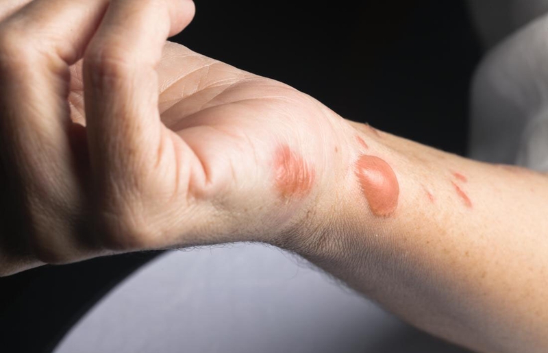 Xử lý vết bỏng bị phồng nước đúng cách để tránh nhiễm trùng